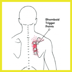 Rhomboid Trigger Points